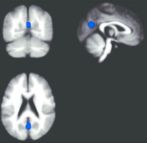 Less Gray Matter Bilaterally In The Precuneus Associated With Longer