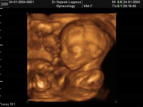 3d Fetal Profile Ultrasound Scan Photos Dr N Layyous