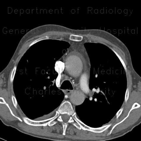 Radiology Case Cteph Chronic Thromboembolic Disease Pulmonary