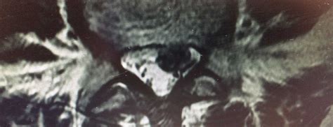 Herniated discs are often associated with shooting pain and. Lumbar Disk Disease (Herniated Disk) | Johns Hopkins Medicine