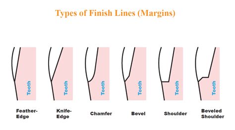 What Are The Types Of Finish Lines Margins Arklign