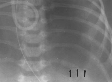 The “diaphanous” Diaphragm A Radiographic Sign Seen After Patch Repair