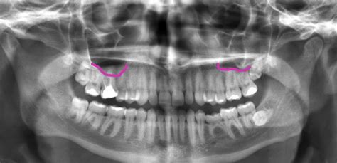 Tooth Pain And Sinuses