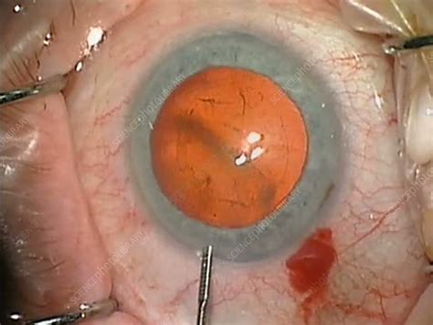 A cataract is a clouding of the natural intraocular crystalline lens that focuses the light entering the eye onto the retina. Cataract surgery - Stock Video Clip - K002/9691 - Science ...