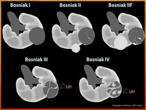 Bosniak Classification Renal Cystic Disease Diagnostic Medical Sonography Radiology Imaging