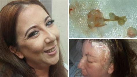 The most common sign of a brain tumor is seizures, especially if these seizures come on for the first time after a dog has passed the age of five years old. Brain tumor turns out to be pork tapeworm video - Strange ...