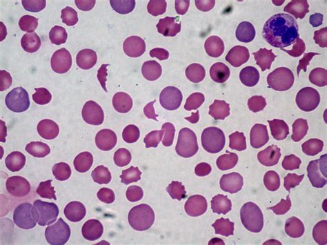 Filedic With Microangiopathic Hemolytic Anemia 301920983