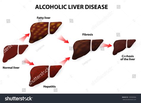 Alcoholic Liver Disease Fatty Liver Fibrosis Stock Illustration