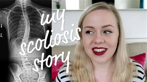Storytime My Scoliosis Story Robowecop Youtube