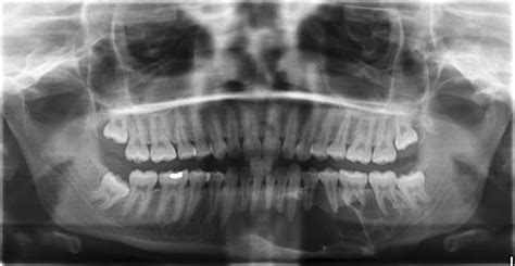 A Panoramic Radiograph Shows Multilocular Radiolucency In Left Body Of