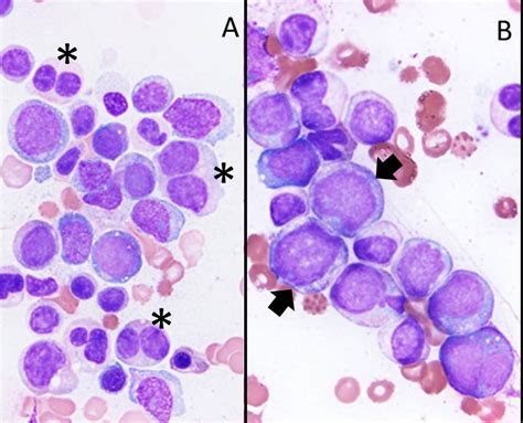 Myelodysplastic Syndrome With Excess Blasts
