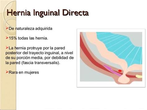 hernia inguinal r2