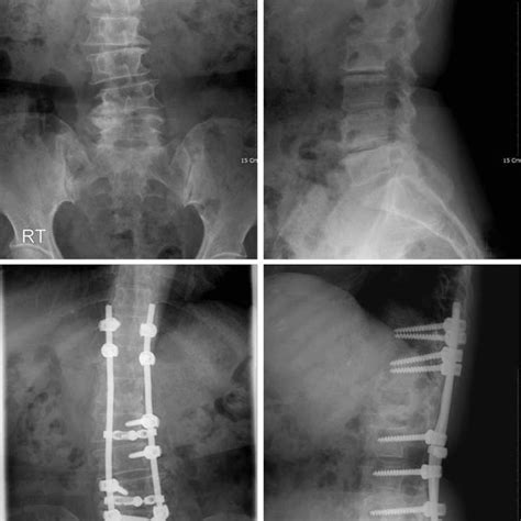 A 52 Year Old Female With Degenerative Scoliosis With Mild Spinal