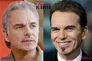 Billy Bob Thornton Plastic Surgery Before and After Botox Injections ...