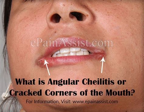 Skin Care Tips That Work For Busy People Cracked Corners Of Mouth Chapped Lips Remedy Mouth