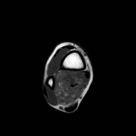 Hemangioma Of Soft Tissue Pathology Orthobullets