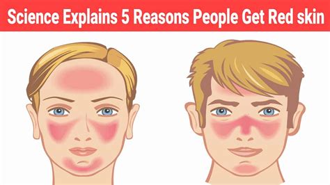 Science Explains 5 Reasons People Get Red Skin Red Skin Heal Red
