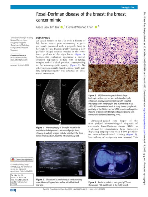 Pdf Rosai Dorfman Disease Of The Breast The Breast Cancer Mimic