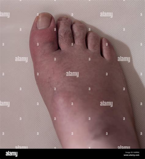 Big Toe With Gout Typical Swelling Inflamation And Skin Peeling Stock
