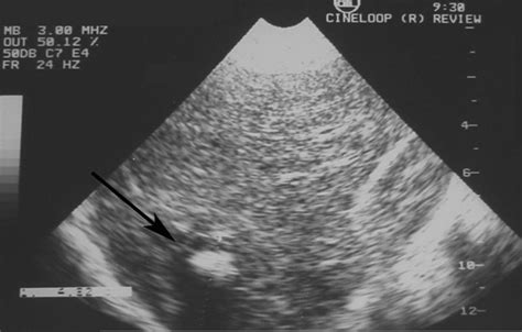 Ultrasound Of The Liver Reveals A Central Hyperechoic Lesion Surrounded