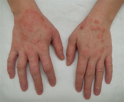 Eczema Symptoms And Treatment Hubpages