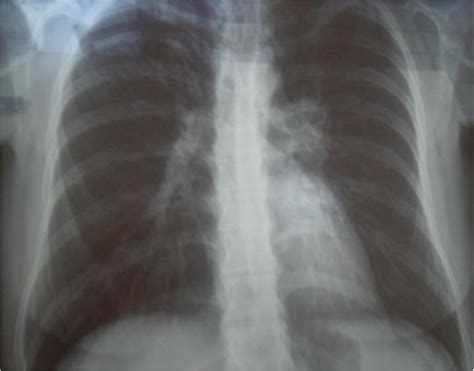 Chest X Ray Chest X Ray Showing A Suspicion Of Hilar Lymphadenopathy
