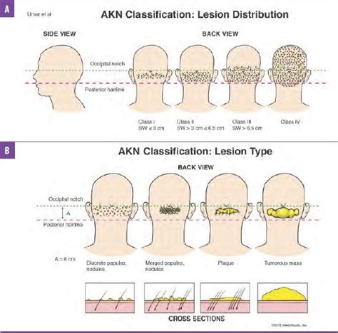 Acne Keloidalis Nuchae Surgical Laser Removal Before And After Picture