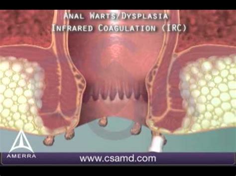 Anal Warts 3D Medical Animation YouTube