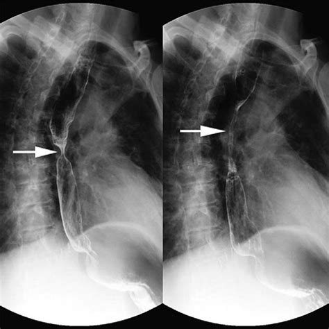 Endoscopy Showing The Esophageal Lumen Stenosis And Normal Mucosa