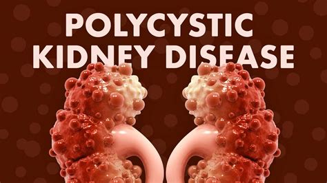 Polycystic Kidney Disease Ausmed