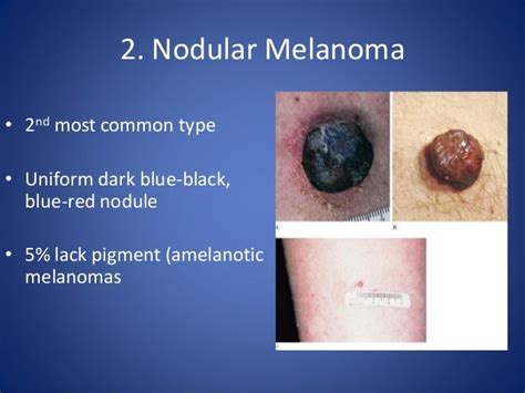 Melanoma Prevention Screening And Diagnosis Dr Ana Ciurea