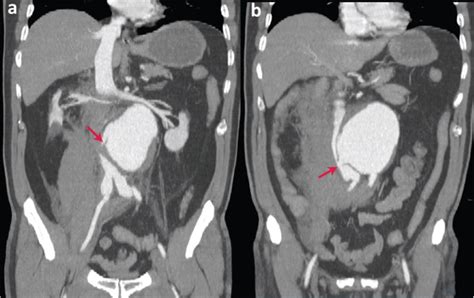 Image Of The Month Abdominal Aorta Aneurysm Rupture In The Peritoneal