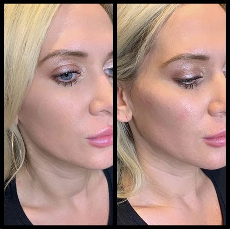 Face Fillers And Cheek Fillers In Gilbert Colair Med Spa