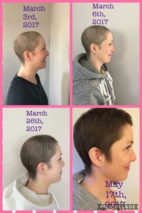 How Long Does It Take For Hair Loss After Chemo The Definitive Guide