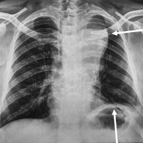 Posteroanterior View Of Chest X Ray Depicting Aortic Arch Aneurysm And