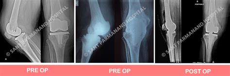 Revision Total Knee Replacement Delhi Institute Of Trauma And Orthopaedics