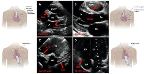 Echocardiographic Screening For The Anomalous Aortic Origin Of Coronary