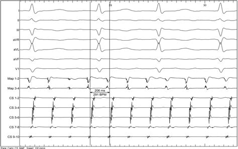 Figure 1 From Radiofrequency Ablation Of The Left Atrial Scar Related