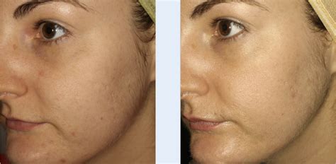 Before After Micro Needling For Acne Scars N N N N Skinsalvation Acne Clinic Usa
