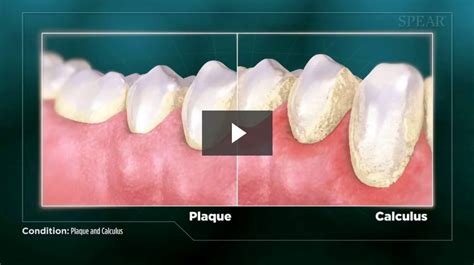 Plaque And Calculus Cosmetic Dentistry