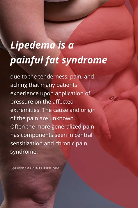 Pin On About Lipedema And Lymphedema