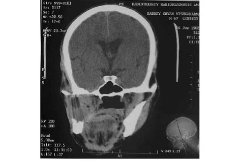 A Contrast Enhanced Ct Scan Face Of The Same Patient In June 2005