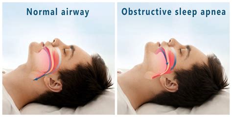 fighting the battle against obstructive sleep apnea the sleep judge