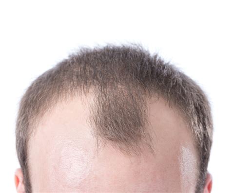 Receding Hairline Stages Parker Trichology