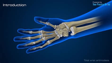 Total Wrist Arthrodesis Hand Wrist Orthopaedics Videos Your Practice Online Education