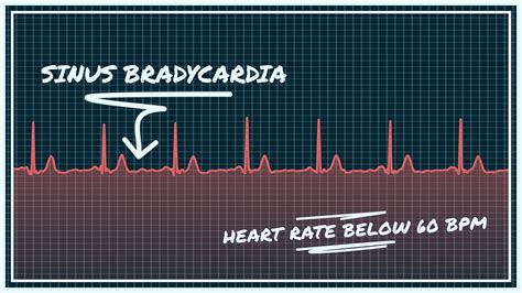 What Sinus Bradycardia Looks Like On Your Watch Ecg Qaly