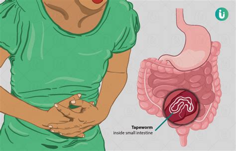 Tapeworm Infection Symptoms Causes Treatment Medicine Prevention Diagnosis
