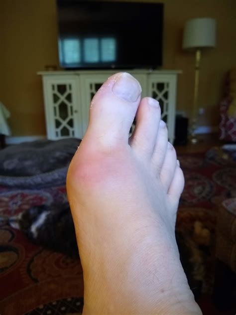 Intermittent Painswelling In Big Toe Joint Mountain Bike Reviews Forum