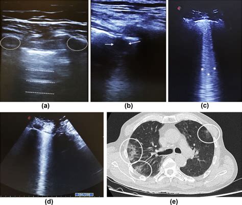 Lung Ultrasonography In Patients With Covid 19 Comparison With Ct