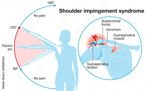 Shoulder Impingement Syndrome Painful Arc Labeled Illustration Stock